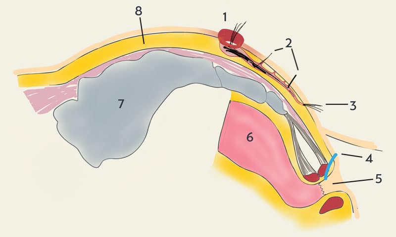 رسم تخطيطي العصعور العصعص، وتسمى أيضا الجيوب الأنفية بيلونيداليس أو الجيوب الأنفية بيلونيدال