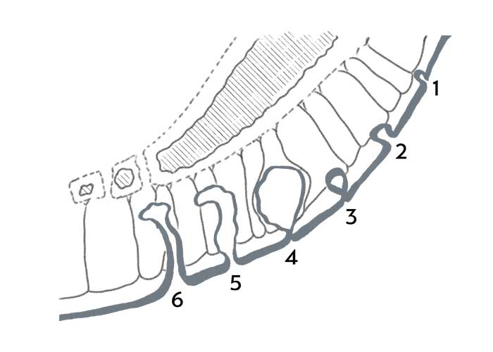 Stadien der Steißbeinfistel Entstehung: 1 Normal, 2 und 3 Steißbeinfistel Frühstadium, 4 - 6 Steißbeinfistel Entstehung