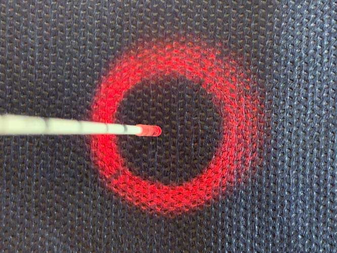 Laser per il trattamento di Fistola sacro coccigea e fistola anale