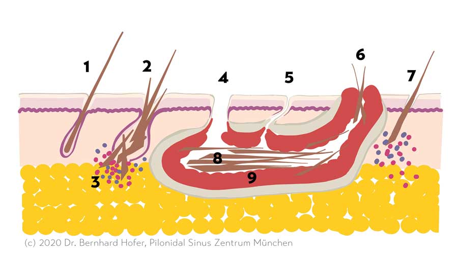Kyste Sacrococcygien (Sinus pilonidal) Cause et origine expliquées dans le schéma