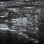 Inflamed, bulky type I B Pilonidal Sinus in ultrasound