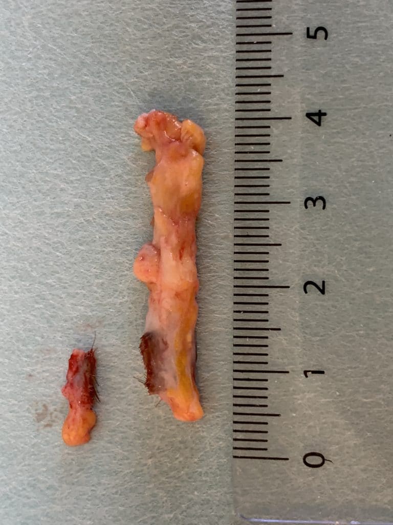 Picture of the removed fistula