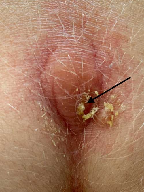 This abscess has risen spontaneously, you can see some dried pus and the normal folding of the skin is already returning