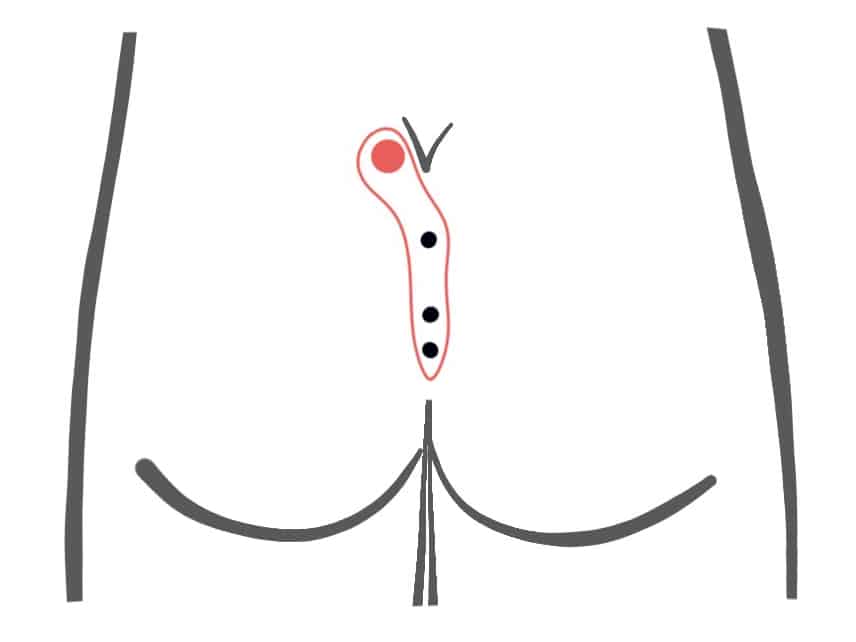 Kyste Sacrococcygien (Sinus pilonidal) images : Régime de type I B fistule