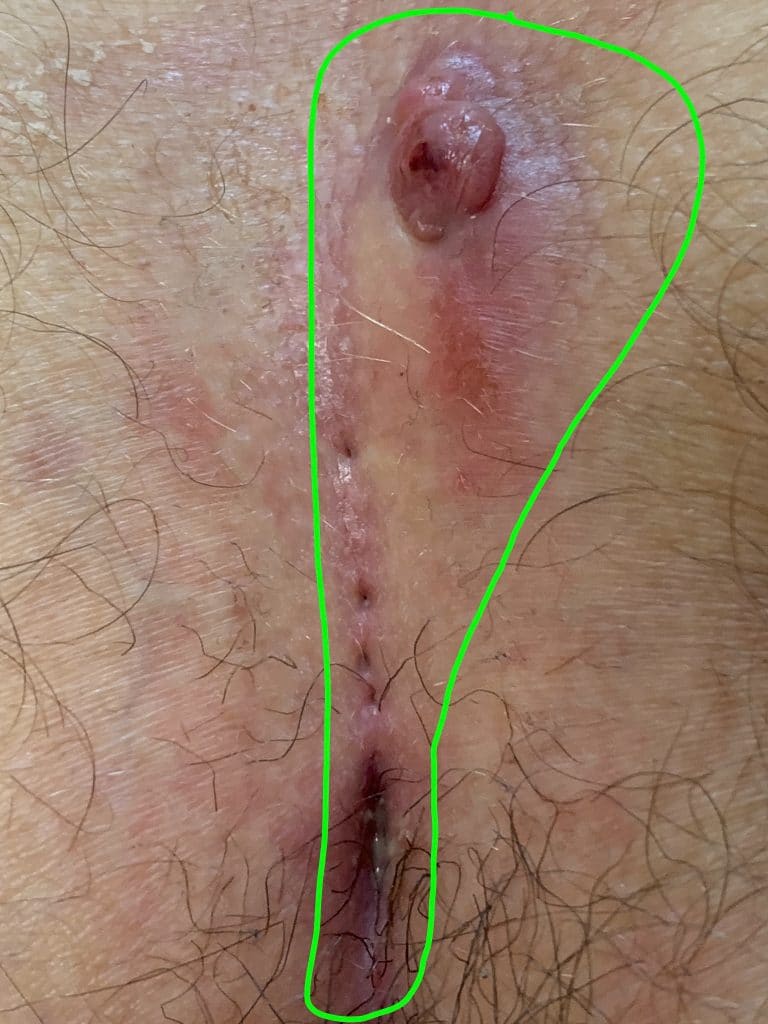 Image d'un Kyste Sacrococcygien (Sinus pilonidal) avec de nombreux orifices primaires et un gonflement au-dessus