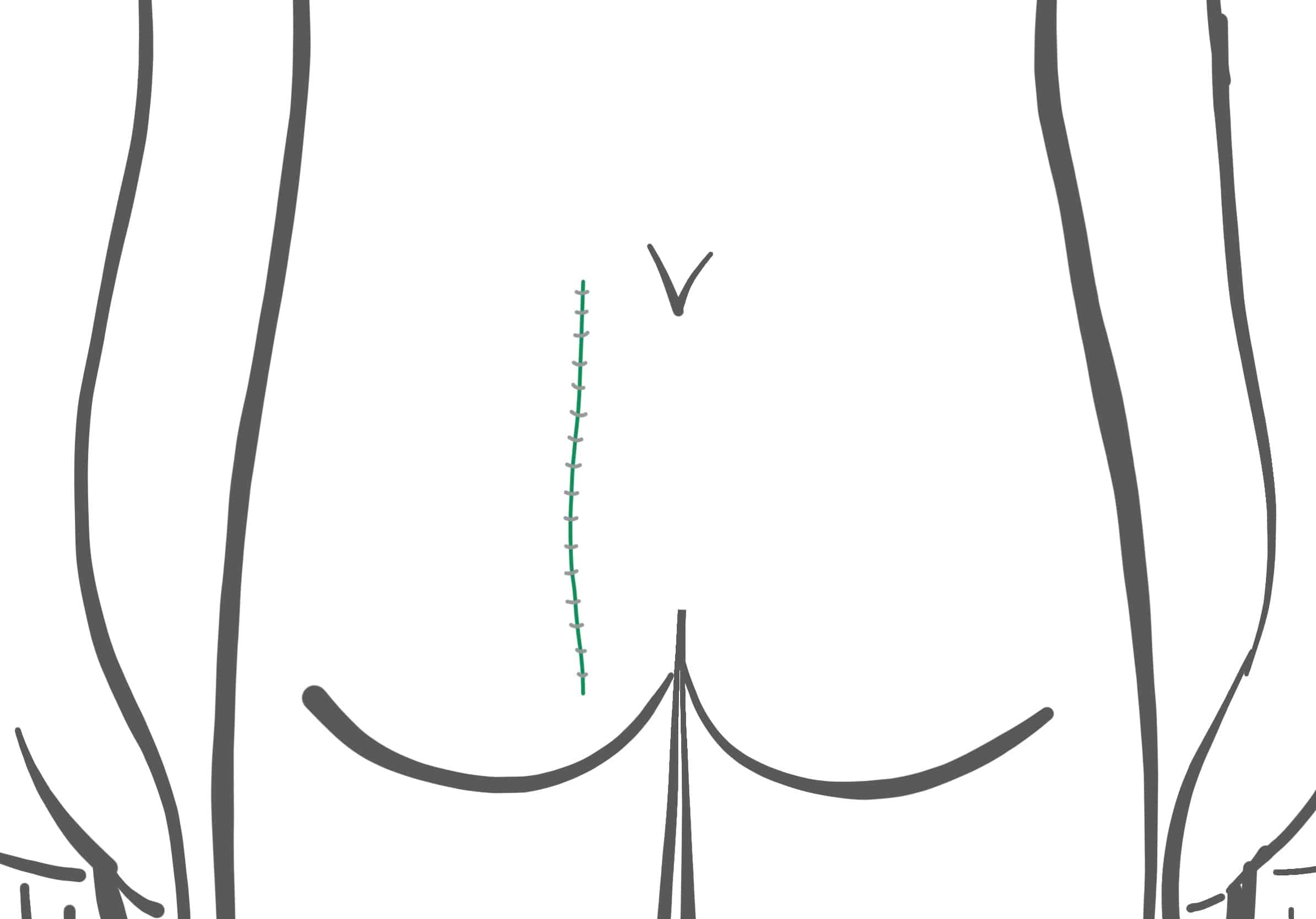 الرسم التخطيطي لجراحة كاريداكيس في نهاية العملية