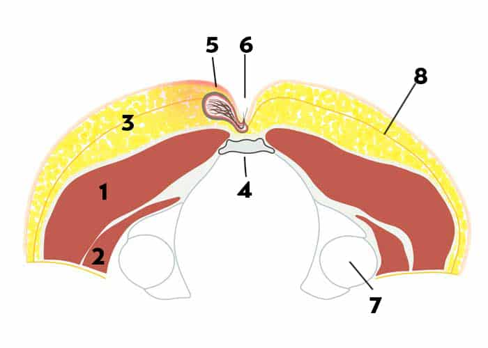 Disegno schematico di un seno pilonidalis in sezione assiale
