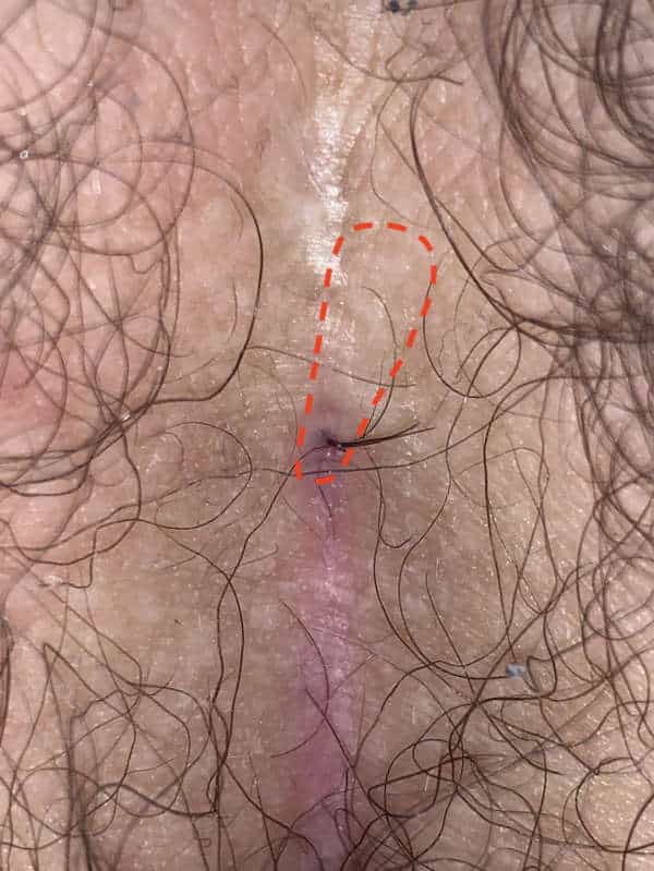 Type I A Fistula with prominent tuft of hair