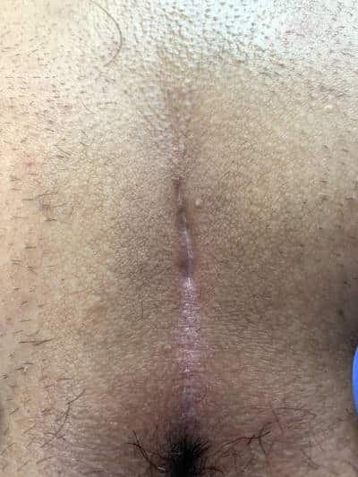 Kyste Sacrococcygien (Sinus pilonidal) Type I A, cicatrice lisse et stable