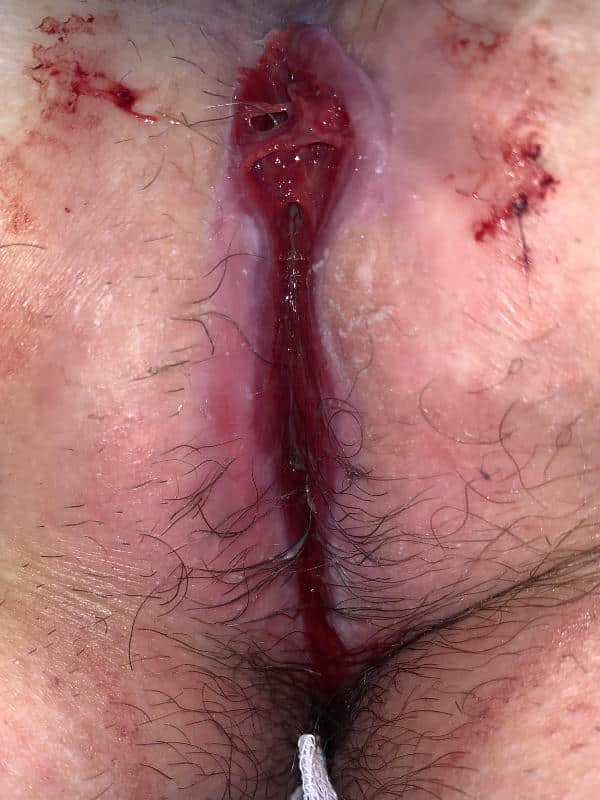 Image of a wound prevented from healing by ingrowing hair
