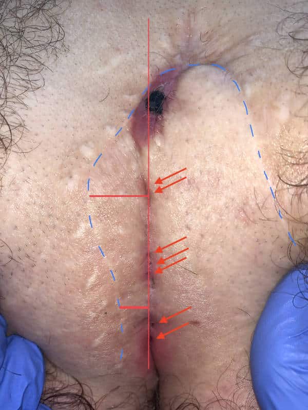 Sinus pilonidalis image with fistula back after Limberg flap