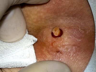 Apertura dell'ascesso del coccige con un punzone da biopsia di 5 mm
