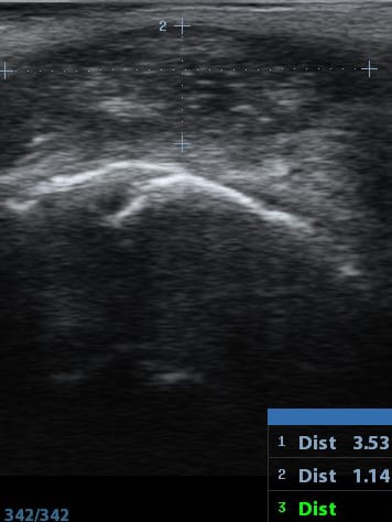 Tip II Kuyruk sokumu fistül ultrasonografi resmi