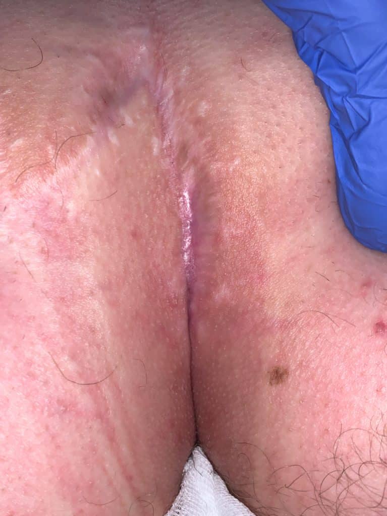 La ferita guarisce dopo la chirurgia e il laser