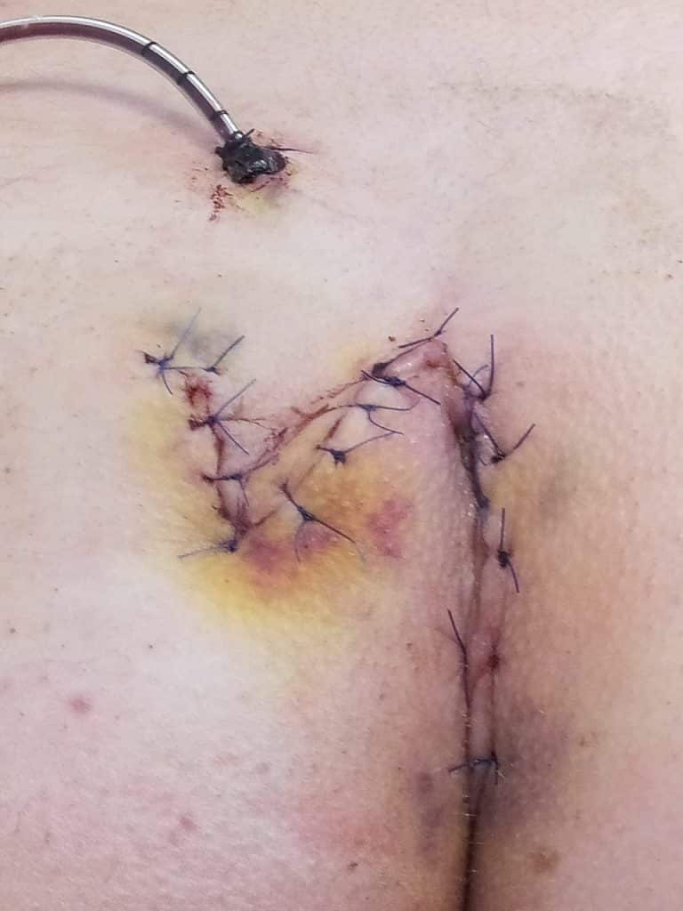Plastique de Limberg après l'opération, plaie suturée