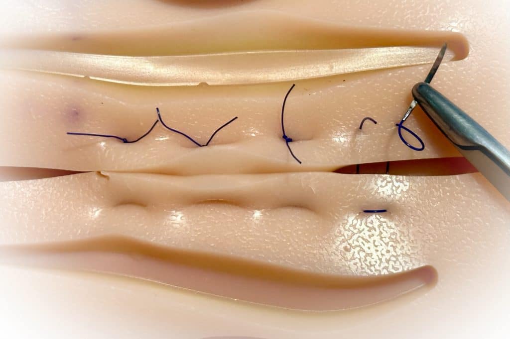 Technique de suture par évasement pour éviter que la suture ne s'ouvre à nouveau après l'opération Kyste Sacrococcygien (Sinus pilonidal)
